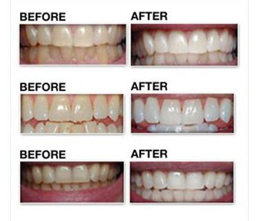 Teeth Whitening Pola Night GEL 4 X 3G18 Carbamide Peroxide Syringes 