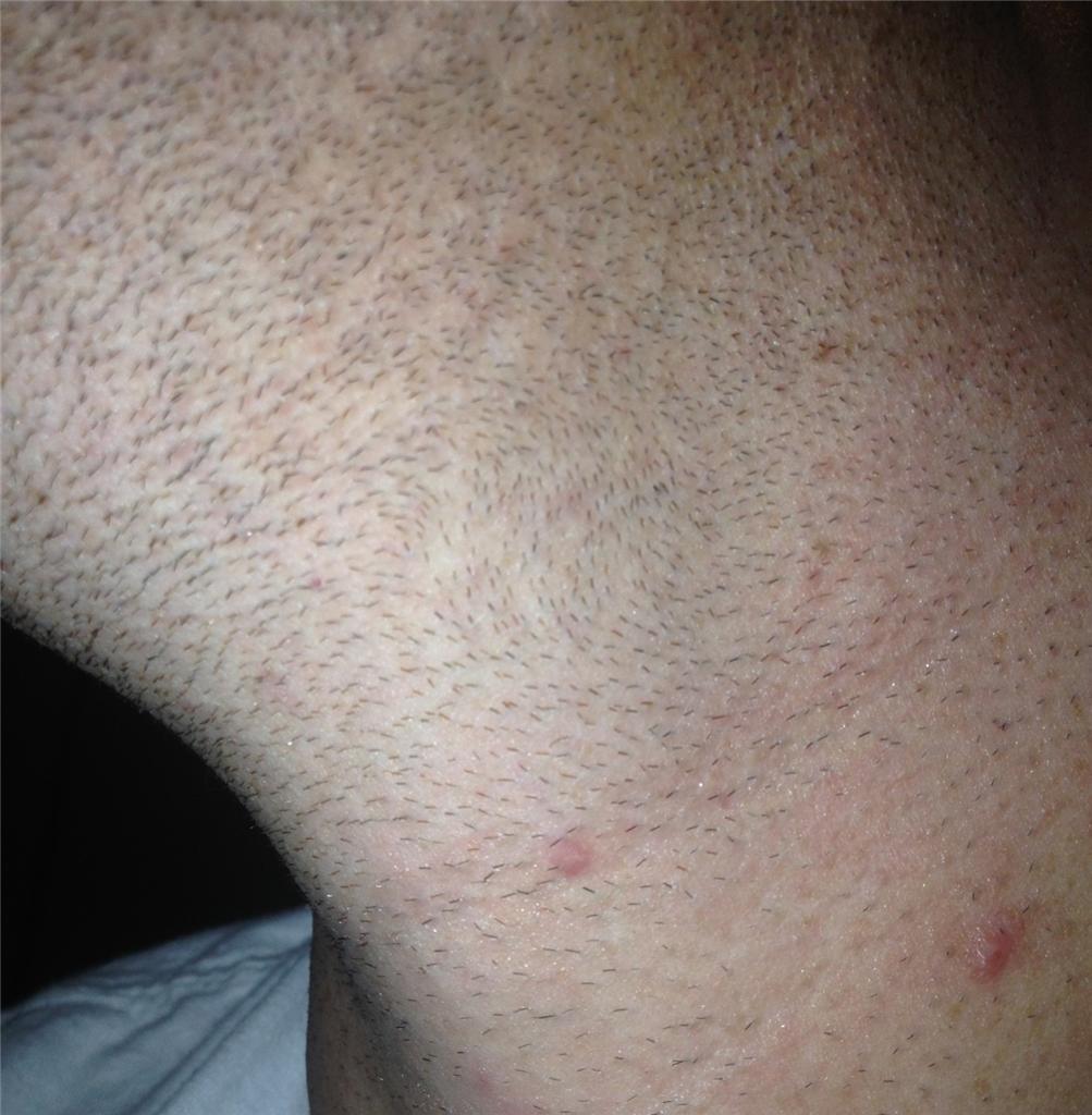 Are These Ingrowns Folliculitis Pseudo Folliculitis Pimples Are These Ingrowns Folliculitis Pseudo Folliculitis Pimples