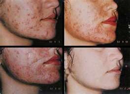 peel acid glycolic acne chemical skin before after deep scars unbuffered wrinkles strength 2008 spots january foo jerrick