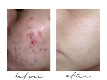 acne peel chemical before tea acid salicylic oil tree lactic night skin